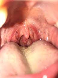 The endocrinologist said it looks suspicious because of is eregular size, 9 x 8 x 7 mm and because it is mixed solid and cystic. Help Does It Look Like I Have Throat Cancer Whatisit