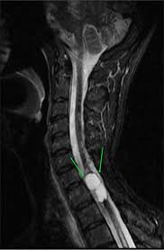 Image result for Syringomyelia