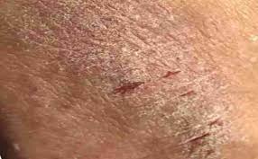 Image result for Neurodermatitis