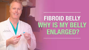 Large (9 cm) fibroid of the uterus which causes pelvic congestion syndrome as seen on ct scan. Fibroid Belly Why Is My Belly Enlarged Youtube