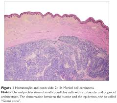 Image result for Merkel Cell Carcinoma