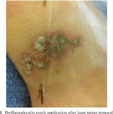 At best, this technique only causes fading of the tattoo. Optimization Of Laser Tattoo Removal Optical Clearing Agents And Multiple Same Day Treatments Via The R0 And R20 Methods Semantic Scholar