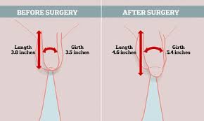 Fat Transfer Penis Enlargement Penis Girth Surgery Androfill