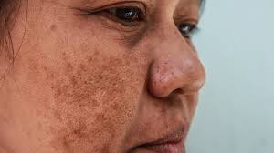 Melasma In Pregnancy Treatment And Causes