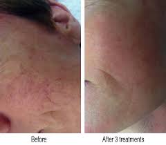 Maybe you would like to learn more about one of these? Non Invasive Broken Capillary Removal In Newcastle
