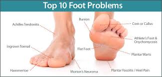Check Out Our List Of The Top 10 Foot Problems Achilles Tendonitis Bunion Corn Or Callus Athlete S Foot Onychomyco Foot Problem Warts Achilles Tendonitis