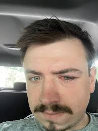 Helichrysum for when you get a stick in your eye