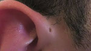 You Might Have Noticed That A Few People Have A Barely Noticeable Hole Where The Top Of Their Ear Cartilage Meets Their Face Believe It Or Ear Cysts Sinusitis