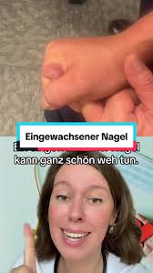 Eingewachsener Nagel Entfernen Mit Eiter