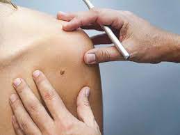 Some cancerous moles and melanoma spots look pretty textbook, and a doctor may strongly suspect that it's melanoma. How To Remove Moles Safe Home Remedies