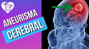 O aneurisma cerebral é uma área fragilizada na parede pela dilatação excessiva de um vaso sanguíneo (aproximadamente 50% do diâmetro normal) que irriga o cérebro, normalmente formando uma protuberância no local. Aneurisma Cerebral Causas Sintomas E Tratamento Youtube