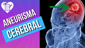 Un aneurisma cerebral es una zona abultada y débil en la pared de una arteria que suministra sangre al cerebro. Aneurisma Cerebral Causas Sintomas E Tratamento Youtube