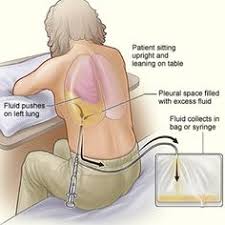 Spl serum mesothelin is a new biomarker for the diagnosis of mesothelioma. 30 Mesothelioma Draft Ideas Mesothelioma Cancer Lunges