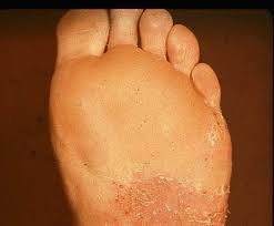 Image result for Tinnea vesiculosa