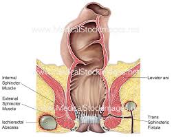 Image result for Perirectal Abscess