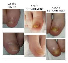 Beaucoup plus rarement, les taches peuvent être liées à l'apparition d'infections plus ou moins graves, allant de la présence d'un champignon à la rougeole, la malaria ou même la lèpre. Mycoses Des Ongles Dermapole