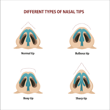 A bulbous tip typically requires an open rhinoplasty to assess the cartilages underneath and refine them as needed. Your Guide To Bulbous Tip Rhinoplasty Causes Treatment Recovery Facial Surgery Aesthetics Center