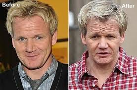 Another Celebrity Hair Transplant Success Story Super Chef Gordon Ramsay Before And After Hair Transplant Hair Transplant Reverse Hair Loss Help Hair Loss