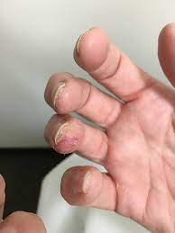 Allergic Contact Dermatitis To Acrylate Chemicals In Artificial Nails Consultant360