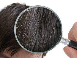 It's not like i'm slathering pure ipp on the face and sleeping on it. Dandruff Fungus On Scalp Symptoms List Of Home Remedies For Dandruff Treatment Health Tips And News