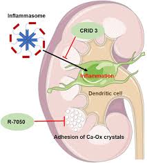 Image result for Calcium Nephrolithiasis