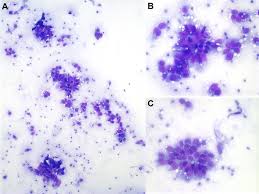 We did not find results for: Cytology Features Of The Papillary Mesothelioma In Non Centrifuged Download Scientific Diagram