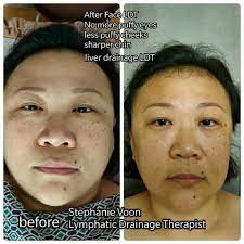 Lymphatic drainage is a manual technique used to stimulate the flow of lymph (a clear fluid that circulates through the body via the lymphatic system) to relieve swelling and improve health. Face Liver Lymphatic Drainage Abliss Therapy Center Facebook