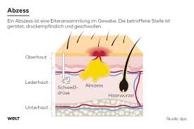 Eingewachsene Haare: Follikulitis, die Entstehung von Abszessen und  Laser-Techniken - WELT