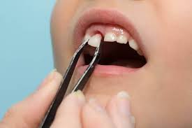 In deinem alter hat man normalerweise keine milchzähne mehr. Milchzahne Die Grossen Geheimnisse Der Ausfallenden Zahne Zahnfreude Com