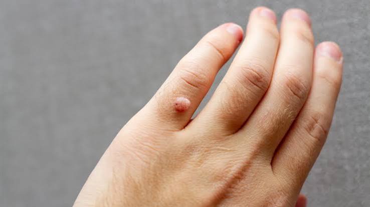 What Is a Skin Lump? Symptoms, Causes, Diagnosis, Treatment, and More