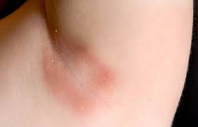How To Lighten Your Armpits In 2020 Yeast Infection Treatment Yeast Infection Causes Yeast Infection Cure