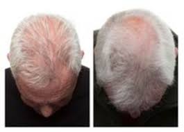 That is the best guarantee that we. Regrowz Claims A 100 Per Cent Success Rate Hair Loss Cure But Does Evidence Back Them Up Daily Mail Online