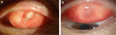 Image result for milium cyst on eyelid