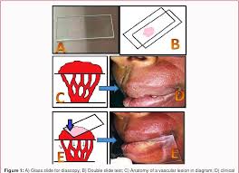 Image result for Diascopy