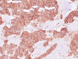 This type of spread is called peritoneal metastasis or carcinomatosis and commonly occurs from cancers that originate from the colon, stomach, appendix, small intestine, ovary, pancreas and peritoneal mesothelioma. E Cadherin Zeta Corporation