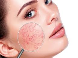 Hermosas en este video les muestro cremas para la cara económicas y buenas para nosotras las de 40 años y más. Rutina Facial Para La Rosacea Dermocosmetica Natural