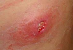These cysts and bumps can be painful, small or big. 8 Boils Or Ingrown Hairs Ideas Ingrown Hair Underarm Hair Ingrown Hair Remedies