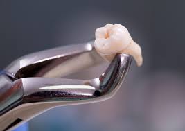Extração do dente: como se preparar para a cirurgia | RIZI