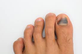 Ingrown toenails (onychocryptosis) result when the toenail grows into the nail fold. Do I Need To Worry About My Black Toenail Torbay Footcare
