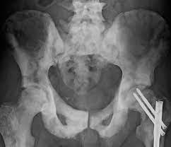 Perthes disease affects a wide age range of children but the most common age range is between 4 and 9. Osteosclerosis Wikipedia