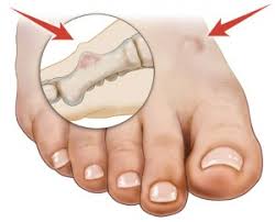 A snapping sound may be heard as the tendon breaks and walking becomes difficult. Bone Tumor Of The Foot Symptoms And Causes