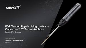Flexor tendon laceration in zones i through v (fig. Arthrex Fdp Tendon Repair Using The Nano Corkscrew Ft Suture Anchors