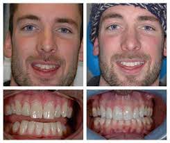 Braces how old do you have to be to get free braces uk. Surrey Incognito Braces Treatment Mulberry Dental