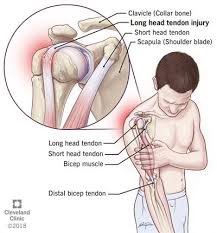 What are the anterior axioappendicular… Biceps Tendon Injuries Causes Symptoms Treatments