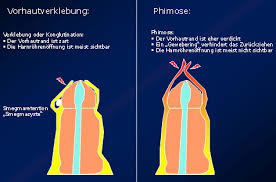 Kräftiger harnstrahl, füllung der vorhaut mit harn (ballonierung) während des wasserlassens möglich Kidsdoc At Vorhautverengung Phimose