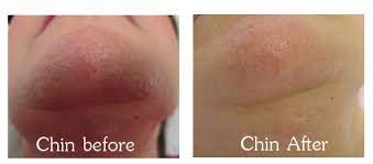 Laser hair removal is newer than electrolysis. Polycystic Ovary Syndrome Pcos And Hair Removal The Laserina Clinic Manchester Trafford