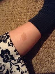 Birthmark On Leg Meaning Close Up Picture Of My Birthmark Shape As Football Of Ancient Christian Symbol Of Mandorla Meaning Of Wholeness Vesica Pisc Christian Symbols Birthmark Mary I