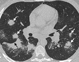 Sarcoidosis is a chronic inflammatory condition that may increase the risk of cancer, but limited information is available on occurrence of cancer in results were generally consistent among ethnic groups, although the increased risk of colon and kidney cancer was observed only in white patients. Pulmonary Sarcoidosis Typical And Atypical Manifestations At High Resolution Ct With Pathologic Correlation Radiographics
