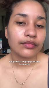 Best Cream for Hyperpigmentation and Dark Spots