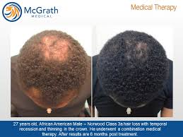 I have seen claims that baldness correlates with higher testosterone levels. Combination Hair Loss Therapy Mcgrath Medical Austin Texas